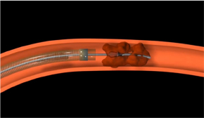 Minimally Invasive Treatment for Acute Cerebral Infarction